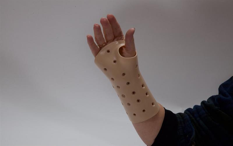 Orthotic Fabrication for Thumb and Wrist Pain: A Supportive Solution